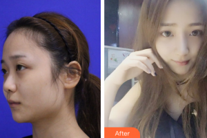 東莞寶格麗醫(yī)療美容門(mén)診部胡峻齊整形價(jià)格表附鼻子塑造案例展示