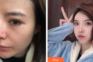 東莞寶格麗醫(yī)療美容門(mén)診部吳波整形價(jià)格表附埋線提升案例展示