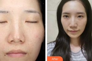 東莞寶格麗醫(yī)療美容門(mén)診部林曉娟整形價(jià)格表附激光祛斑案例展示