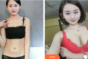 東莞市第六人民醫(yī)院醫(yī)療美容中心顏小武整形價(jià)格表附自體脂肪豐胸案例展示