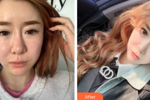 東莞仁康醫(yī)院整形美容中心郭靜蘋整形價(jià)格表附埋線提升案例展示