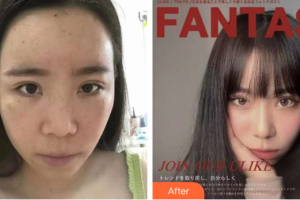 東莞美立方美容醫(yī)院張克整形價(jià)格表附切開(kāi)重瞼+內(nèi)眥贅皮矯正案例展示