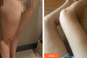 東莞同濟(jì)光華醫(yī)院口腔科郭愛(ài)華整形價(jià)格表附大腿吸脂案例展示