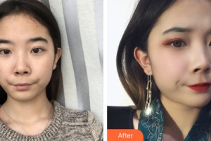 河南整形美容醫(yī)院尹趙心整形價(jià)格表附皮膚美容案例展示