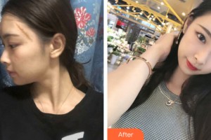 河南大學(xué)附屬南石醫(yī)院燒傷整形美容中心楊洪整形價(jià)格表附皮膚美容案例展示