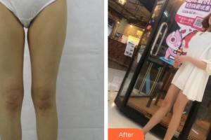 河南協(xié)和醫(yī)院整形外科翟紹旭整形價(jià)格表附大腿吸脂案例展示