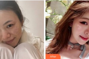 河南省現(xiàn)代醫(yī)學(xué)研究院中醫(yī)院七星整形美容中心劉亞輝整形價(jià)格表附皮膚美容案例展示