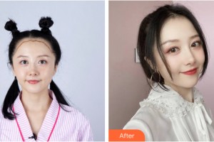 河南省整形美容研究中心宋海林整形價(jià)格表附植發(fā)案例展示