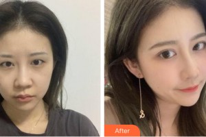 河南協(xié)和醫(yī)院整形外科騰利整形價格表附眼部手術(shù)案例展示