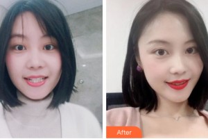 武警河南省總隊醫(yī)院激光整形中心路學(xué)文整形價格表附牙齒矯正案例展示