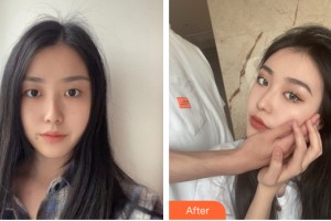 河南整形美容醫(yī)院李永峰整形價格表附雙眼皮手術(shù)案例展示