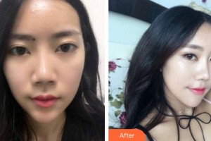 河南中醫(yī)藥大學(xué)第一附屬醫(yī)院整形美容科姜建芳整形價格表附隆鼻手術(shù)案例展示