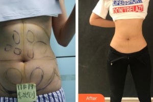 河南中醫(yī)藥大學(xué)第一附屬醫(yī)院整形美容科郭金冉整形價格表附腰腹吸脂案例展示