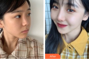 河南一科整形美容醫(yī)院吳利永整形價格表附隆鼻手術(shù)案例展示