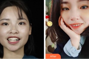 海南口腔醫(yī)院王俊杰整形價格表附牙齒矯正案例展示