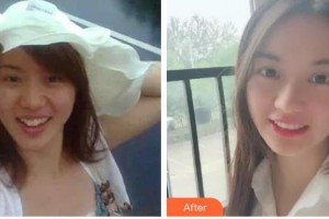 廣東藥科大學(xué)附屬第三醫(yī)院整形美容科黃羨整形價(jià)格表附金屬托槽矯正案例展示