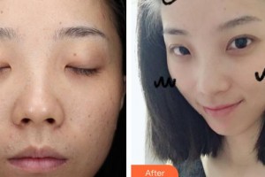 廣東藥科大學(xué)附屬第三醫(yī)院整形美容科巫尾英整形價(jià)格表附激光點(diǎn)痣案例展示