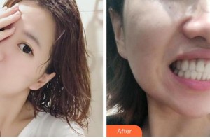 廣東藥科大學附屬第三醫(yī)院整形美容科安宇寧整形價格表附牙齒陶瓷矯正案例展示