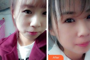 廣東省婦幼保健院整形美容中心胡葵葵整形價格表附牙貼面案例展示