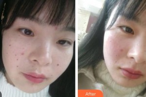 武警廣東總隊醫(yī)院整形美容中心朱彤玥整形價格表附激光點痣案例展示