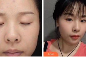 武警廣東總隊醫(yī)院整形美容中心趙新央整形價格表附光子嫩膚案例展示