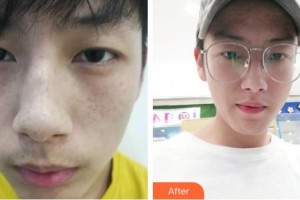 云南華美美萊美容醫(yī)院蘭云整形價格表附祛斑祛痣案例展示