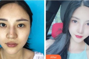 云南華美美萊美容醫(yī)院D.Sherman(舒曼)整形價格表附下瞼整形案例展示