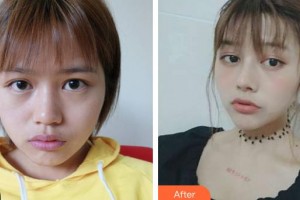 云南銅雀臺整形美容醫(yī)院陶俊院長整形價格表附鼻部綜合案例展示