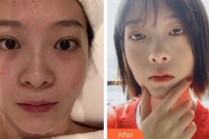 云南華美美萊美容醫(yī)院俞滿昌整形價格表附水氧活膚案例展示