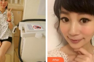 云南華美美萊美容醫(yī)院Lemperle(藍(lán)博)整形價格表附鐳射凈膚案例展示