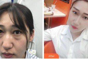 云南中醫(yī)學(xué)院附設(shè)中醫(yī)醫(yī)院整形美容中心張巍巍整形價格表附激光去眼袋案例展示