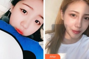 武警云南省邊防總隊醫(yī)院整形美容中心楊俊濤整形價格表附眼部綜合案例展示