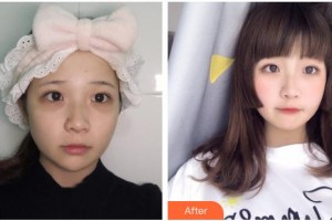 武警云南省邊防總隊醫(yī)院整形美容中心陶長偉整形價格表附外切祛眼袋案例展示