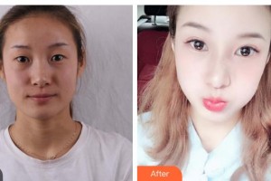 云南瑪麗亞整形美容醫(yī)院陳志棟整形價格表附切開雙眼皮案例展示