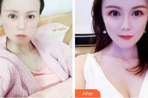 武警云南省邊防總隊醫(yī)院整形美容中心王強(qiáng)整形價格表附假體隆胸案例展示