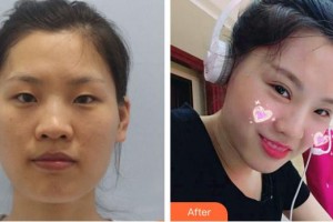 武警云南省邊防總隊醫(yī)院整形美容中心石林整形價格表附切開雙眼皮案例展示