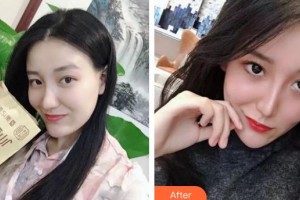 云南華美美萊美容醫(yī)院黃夢婷整形價格表附清潔祛痘案例展示