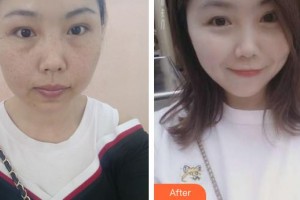 云南華美美萊美容醫(yī)院路秀波整形價格表附激光祛斑案例展示