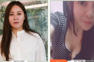 云南銅雀臺整形美容醫(yī)院林沸騰整形價格表附激光溶脂案例展示