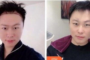 武警云南省邊防總隊醫(yī)院整形美容中心刁永鋒整形價格表附種植發(fā)際線案例展示