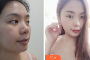 云南中醫(yī)學院附設中醫(yī)醫(yī)院整形美容中心李麗潔整形價格表附無針水光案例展示