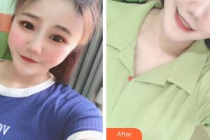 武警云南省邊防總隊醫(yī)院整形美容中心舒勇整形價格表附清潔祛痘案例展示