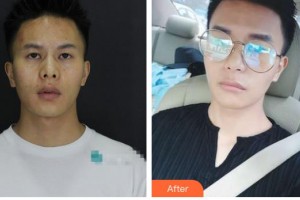 云南妤繡醫(yī)療美容診所吳建華整形價格表附光子嫩膚案例展示