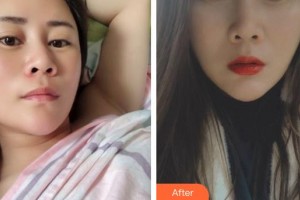 云南省第一人民醫(yī)院眼科楊崢嶸整形價格表附水氧活膚案例展示