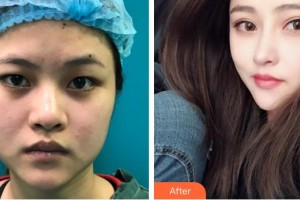 云南銅雀臺整形美容醫(yī)院丁蓓蓓整形價格表附切開雙眼皮案例展示