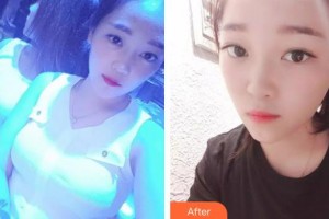 云南高原皮膚病醫(yī)院張順武整形價格表附白瓷娃娃案例展示