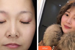 云南銅雀臺整形美容醫(yī)院楊云東院長整形價格表附激光祛斑】案例展示