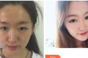 云南省第一人民醫(yī)院眼科梅妍整形價格表附激光去眼袋案例展示