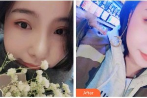 云南德普口腔醫(yī)院鄧艷整形價格表附牙齒隱形矯正案例展示