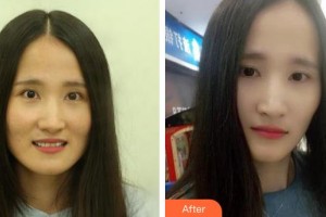 云南竹子口腔醫(yī)院萬碧濤整形價格表附牙齒陶瓷矯正案例展示